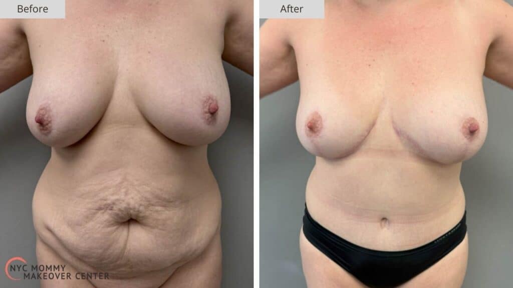 Mommy Makeover NYC Before and After #2a