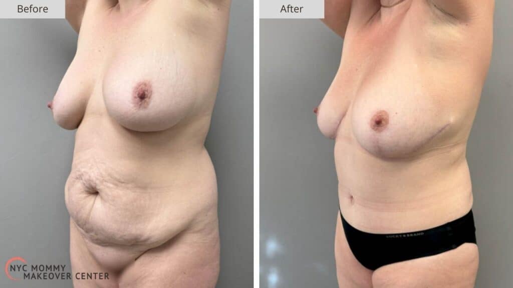 Mommy Makeover NYC Before and After #2b