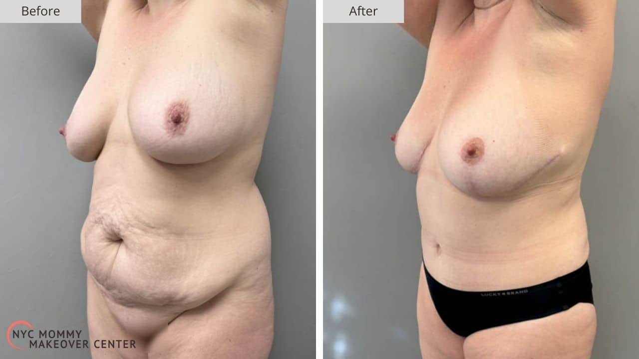 Mommy Makeover NYC Before and After #2b