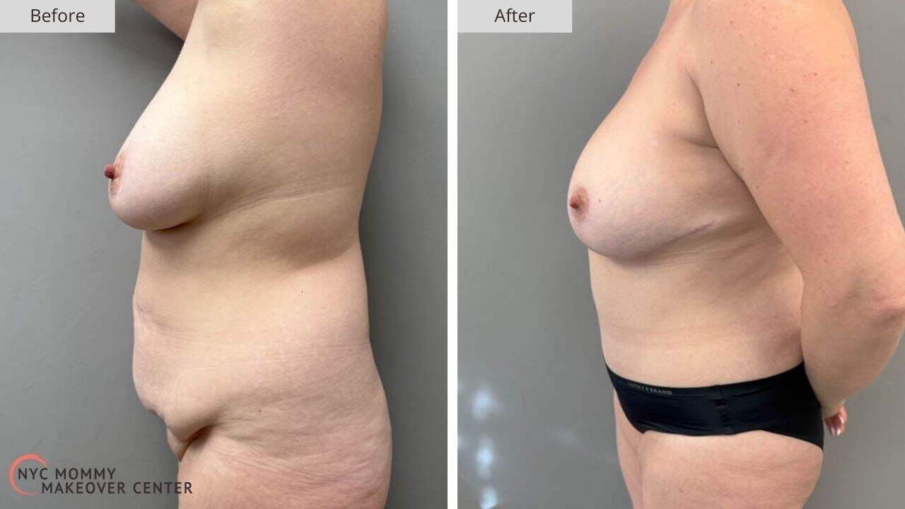 Mommy Makeover NYC Before and After #2c
