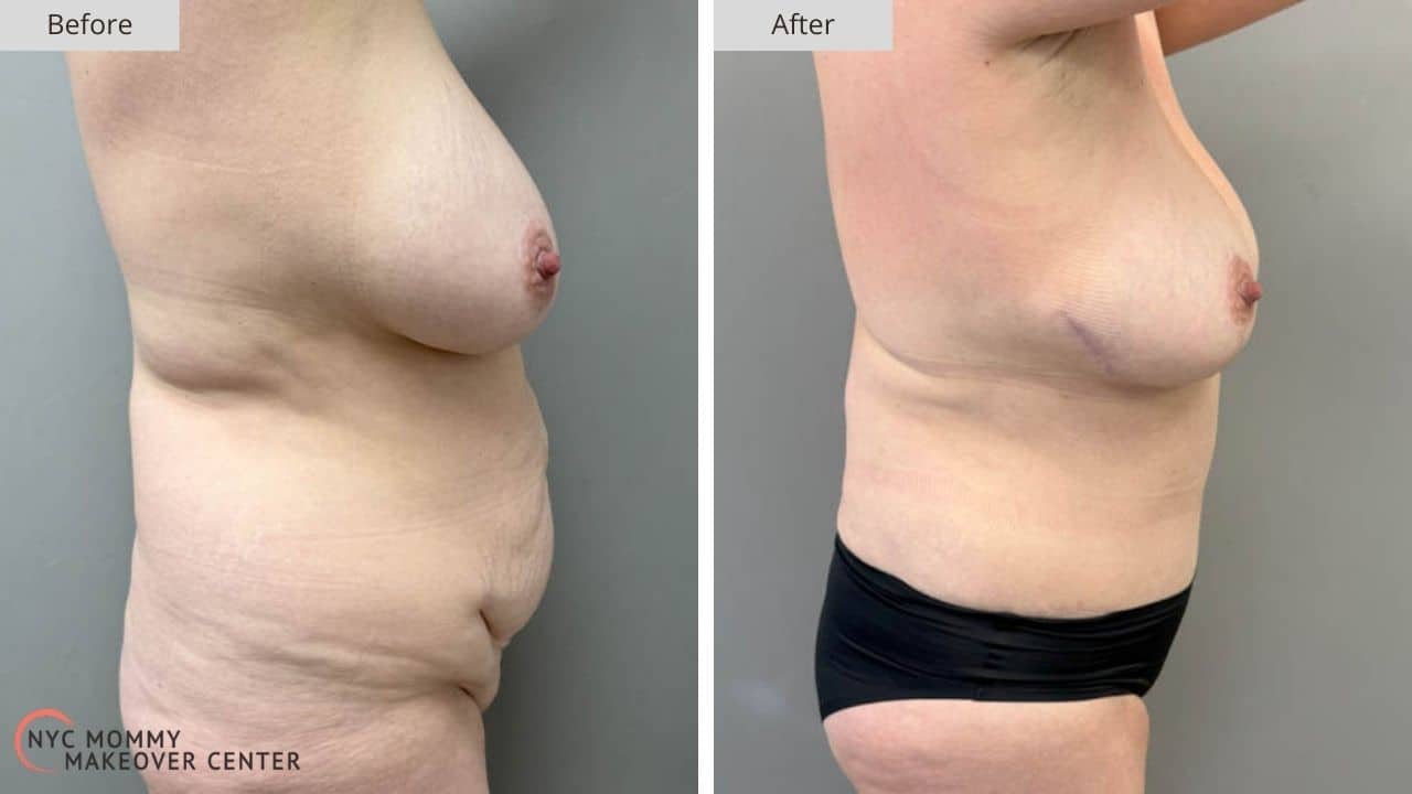 Mommy Makeover NYC Before and After #2d