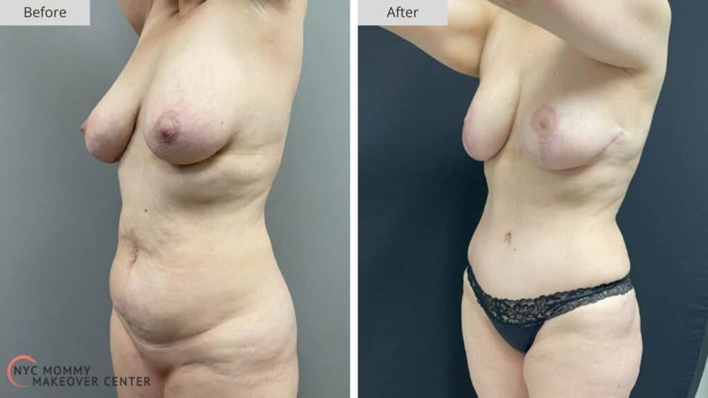 Mommy Makeover NYC Before and After #3a