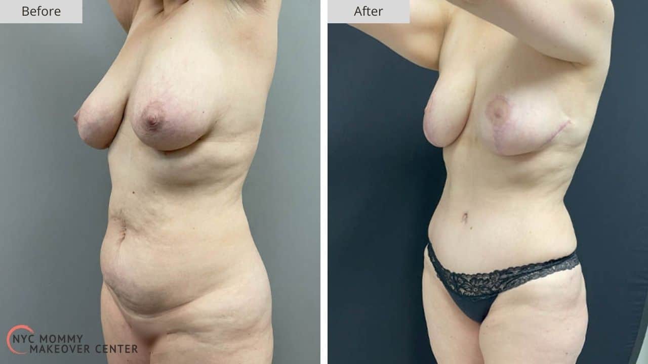 Mommy Makeover NYC Before and After #3a