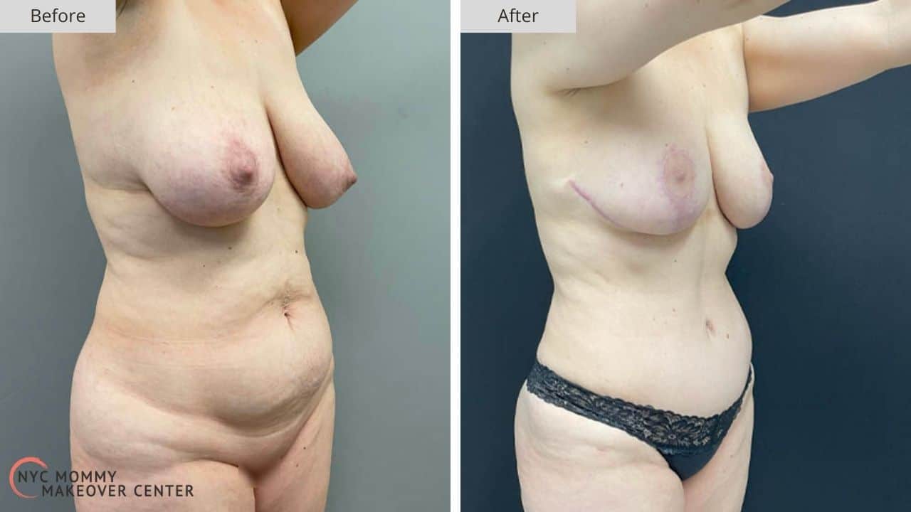 Mommy Makeover NYC Before and After #3b