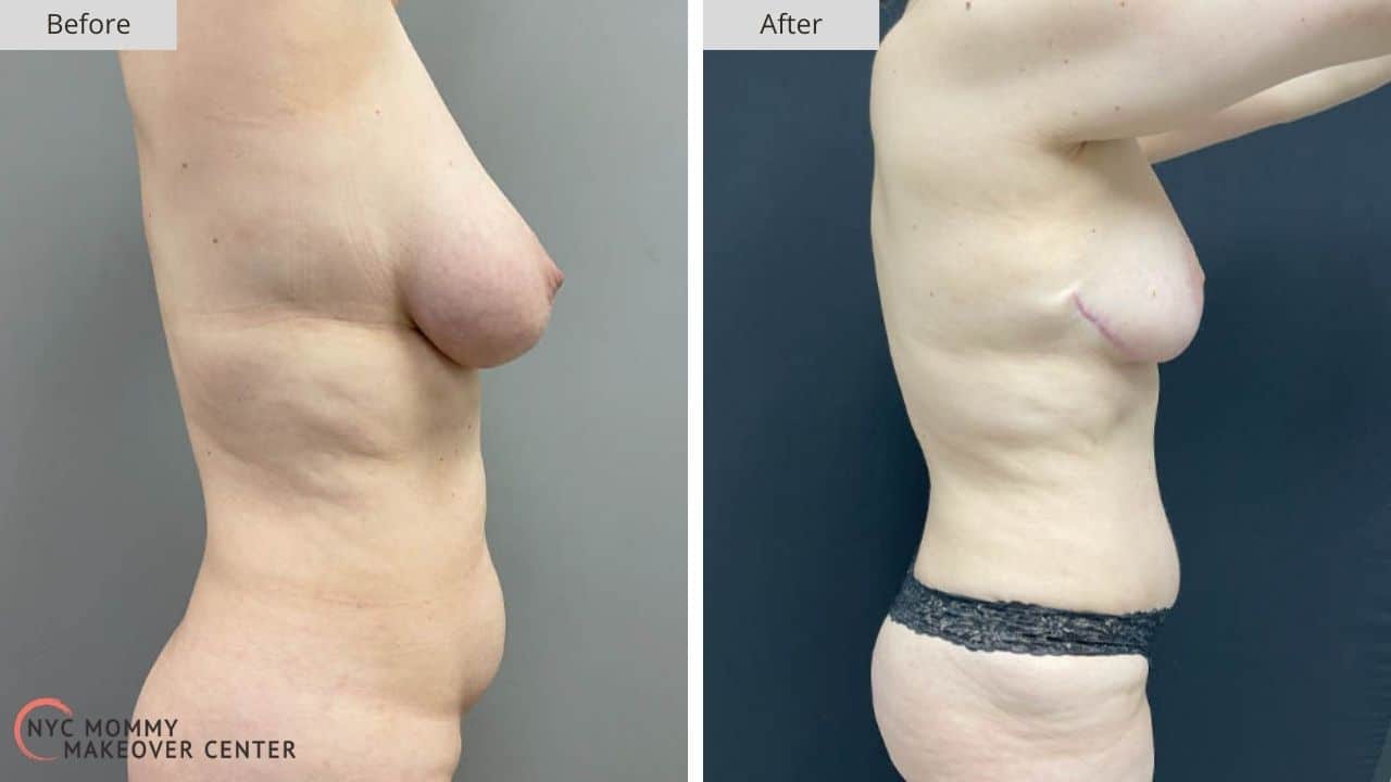 Mommy Makeover NYC Before and After #3c