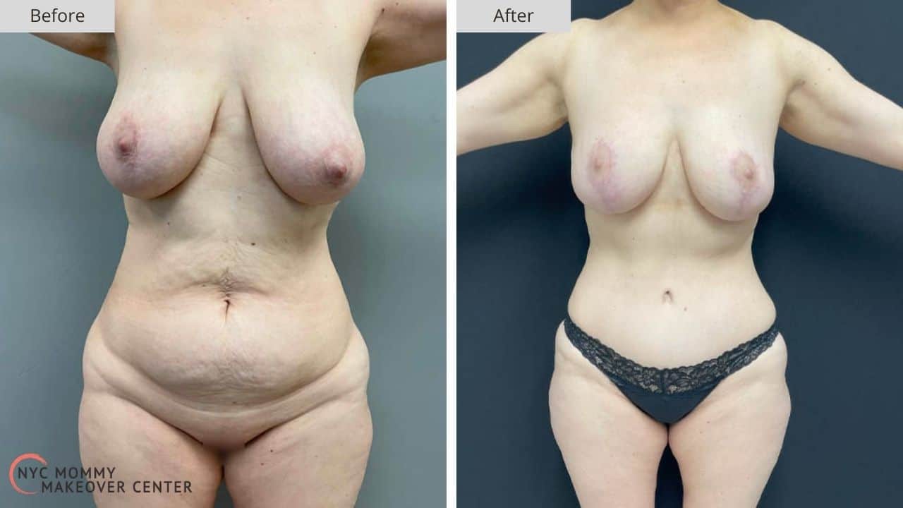 Mommy Makeover NYC Before and After #3d