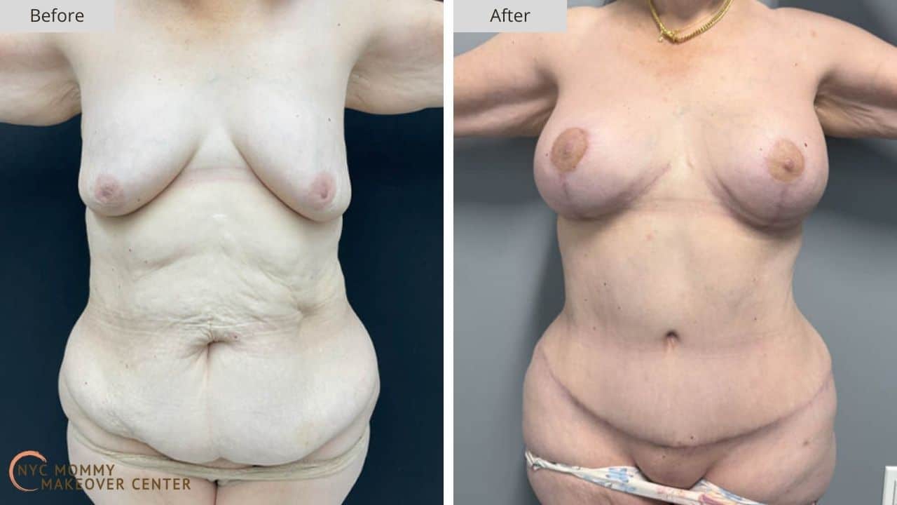 Mommy Makeover NYC Before and After #4a