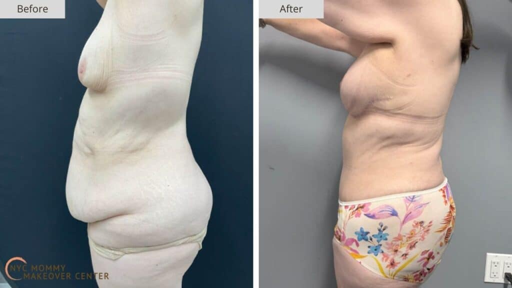 Mommy Makeover NYC Before and After #4b