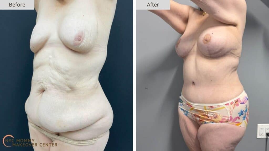 Mommy Makeover NYC Before and After #4c