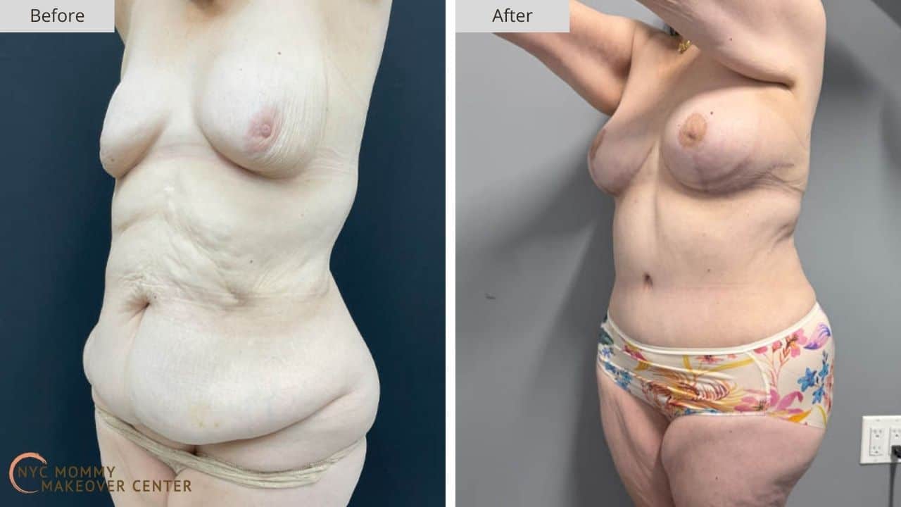 Mommy Makeover NYC Before and After #4c