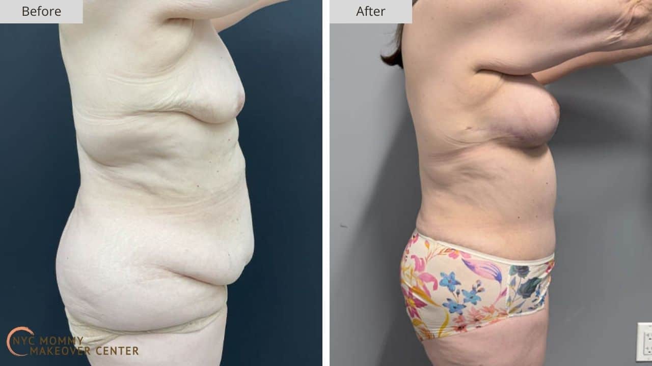 Mommy Makeover NYC Before and After #4d