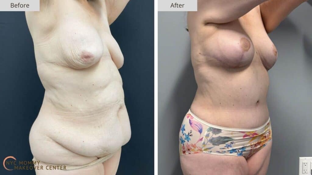 Mommy Makeover NYC Before and After #4e