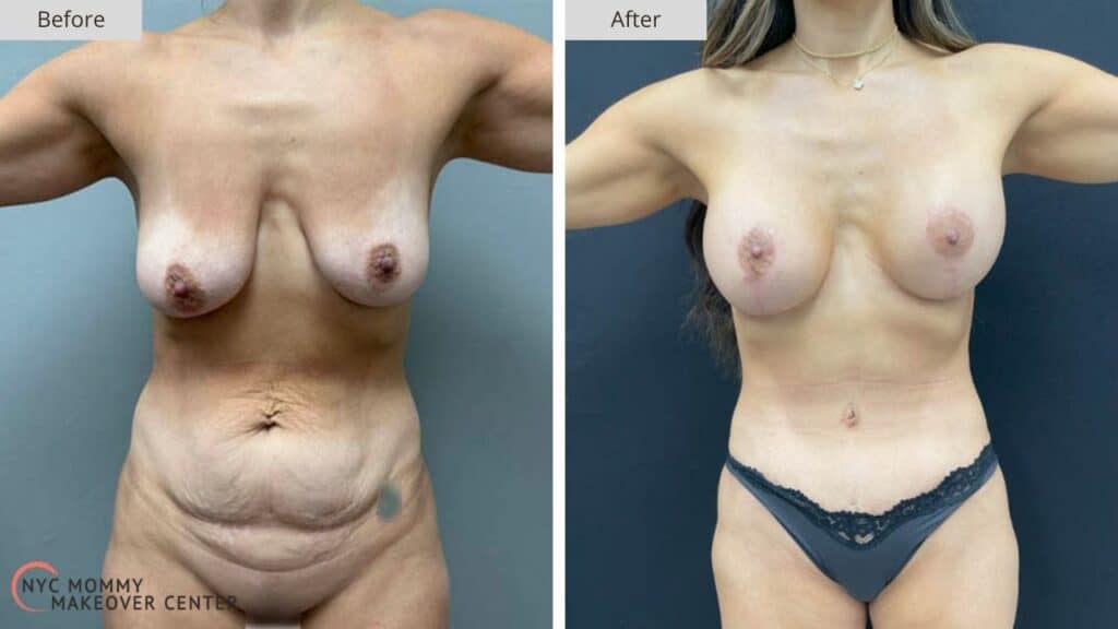 Mommy Makeover NYC Before and After #5a