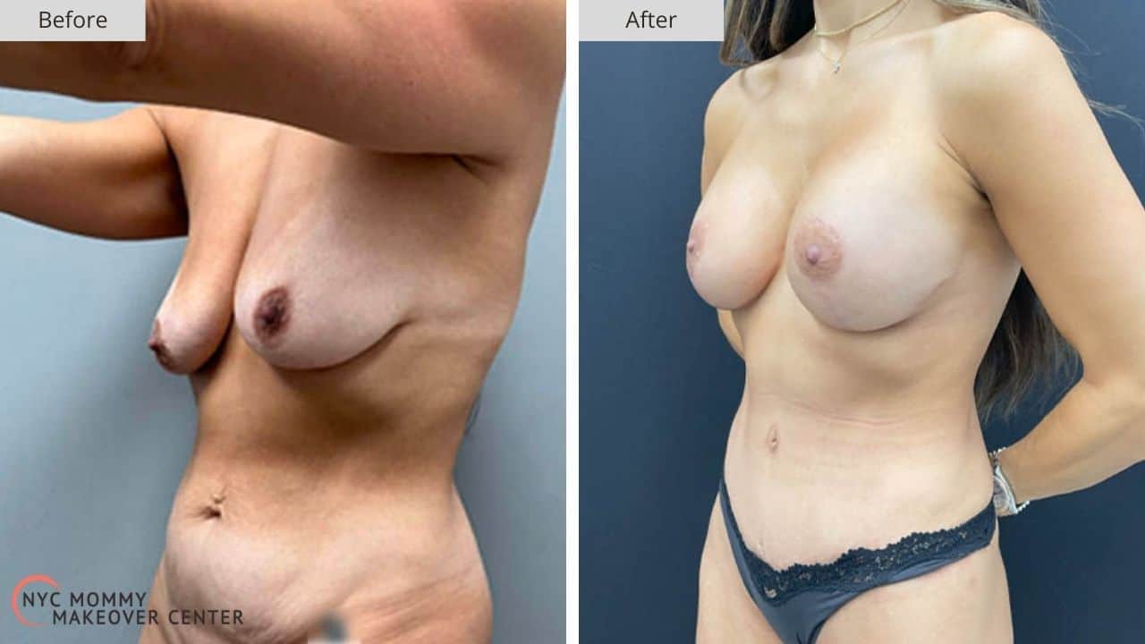 Mommy Makeover NYC Before and After #5b