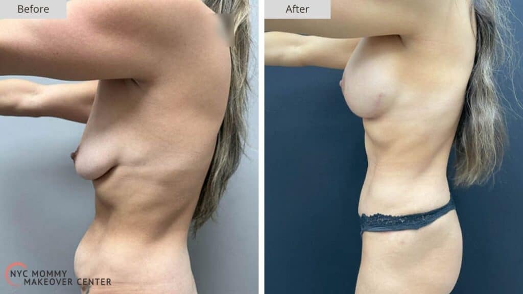 Mommy Makeover NYC Before and After #5c