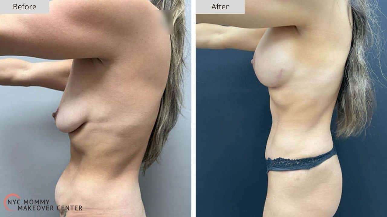 Mommy Makeover NYC Before and After #5c