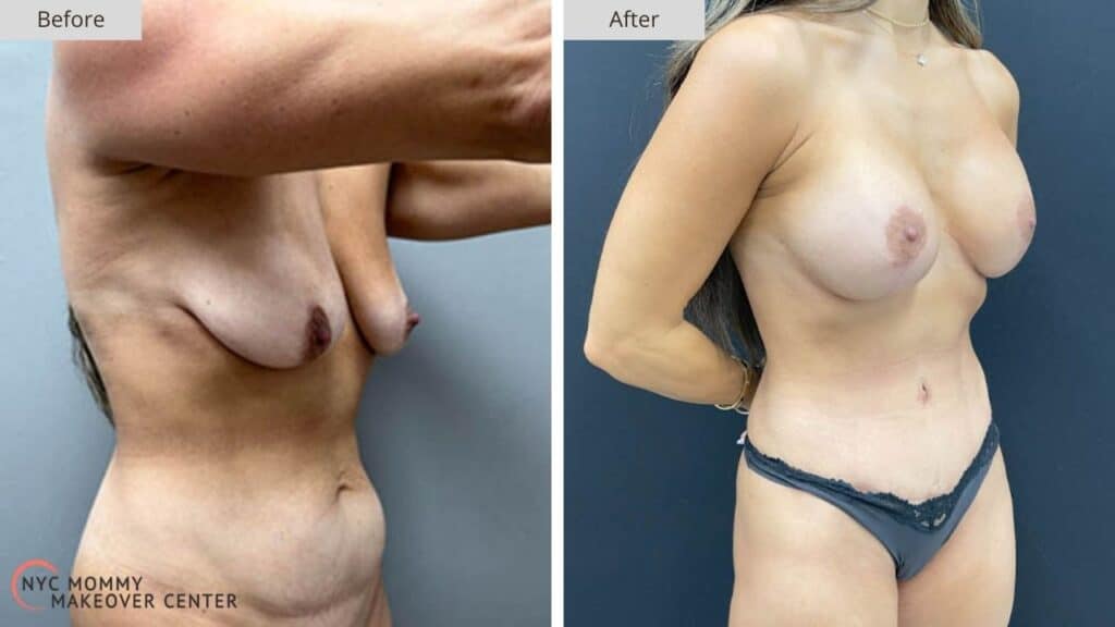Mommy Makeover NYC Before and After #5d
