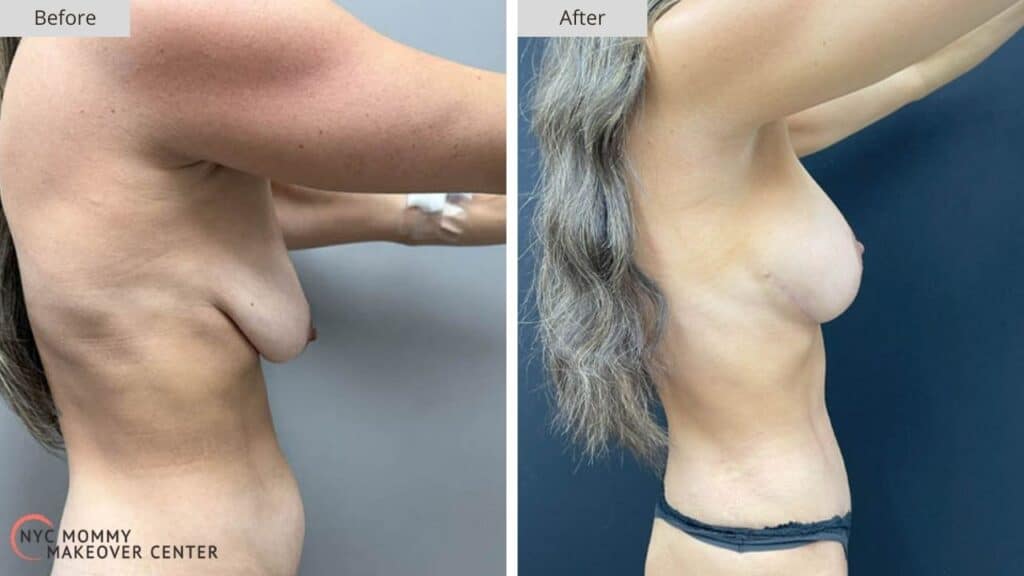 Mommy Makeover NYC Before and After #5e