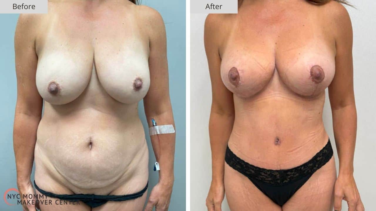 Mommy Makeover NYC Before and After #6a