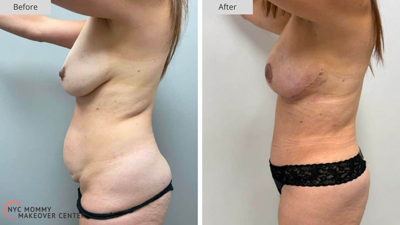 Mommy Makeover NYC Before and After #6b