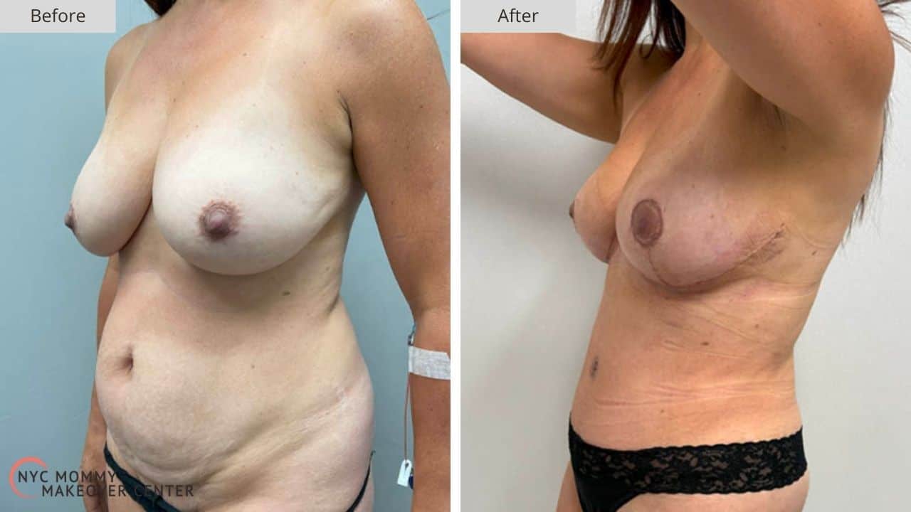 Mommy Makeover NYC Before and After #6c