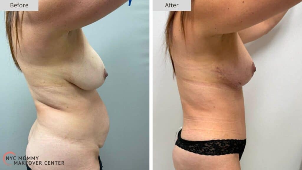 Mommy Makeover NYC Before and After #6d