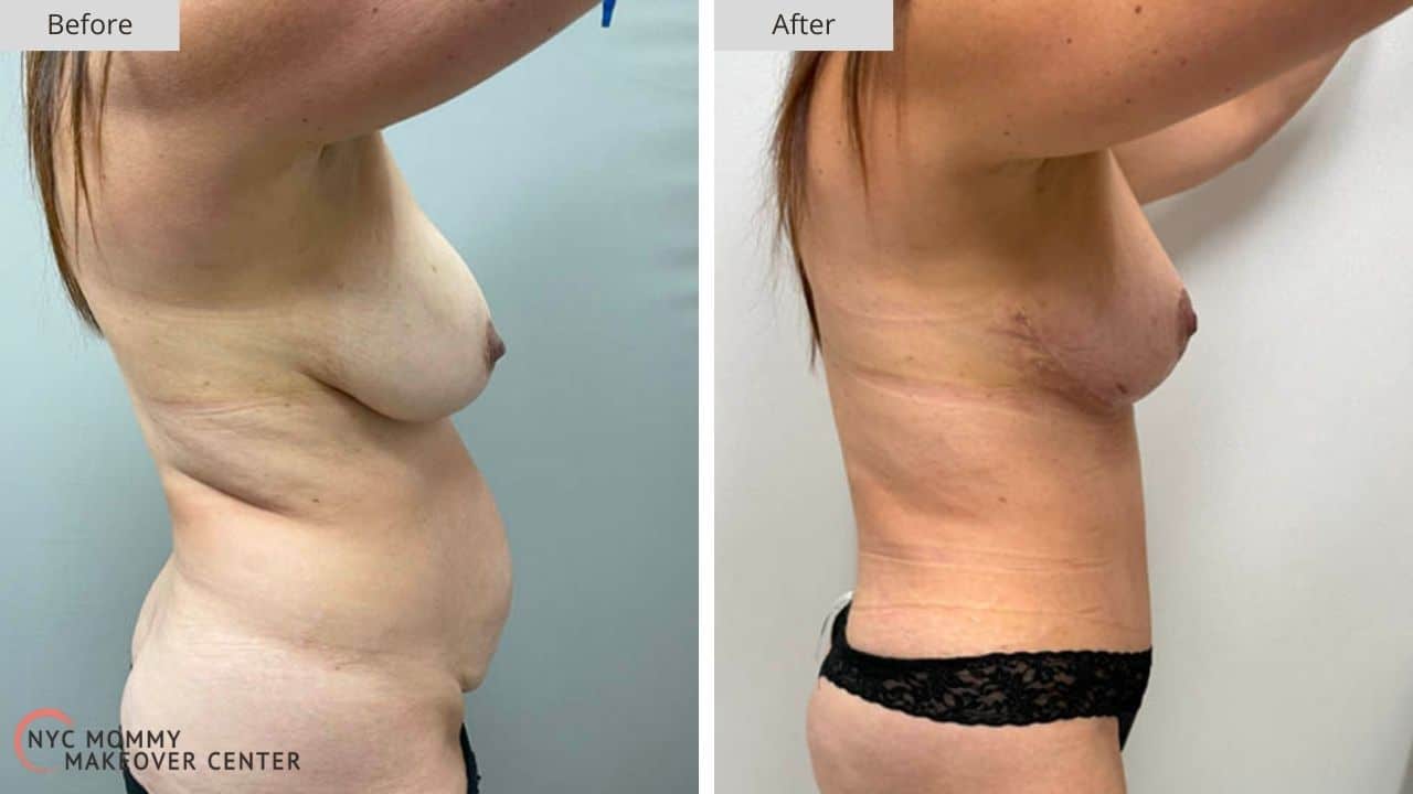 Mommy Makeover NYC Before and After #6d