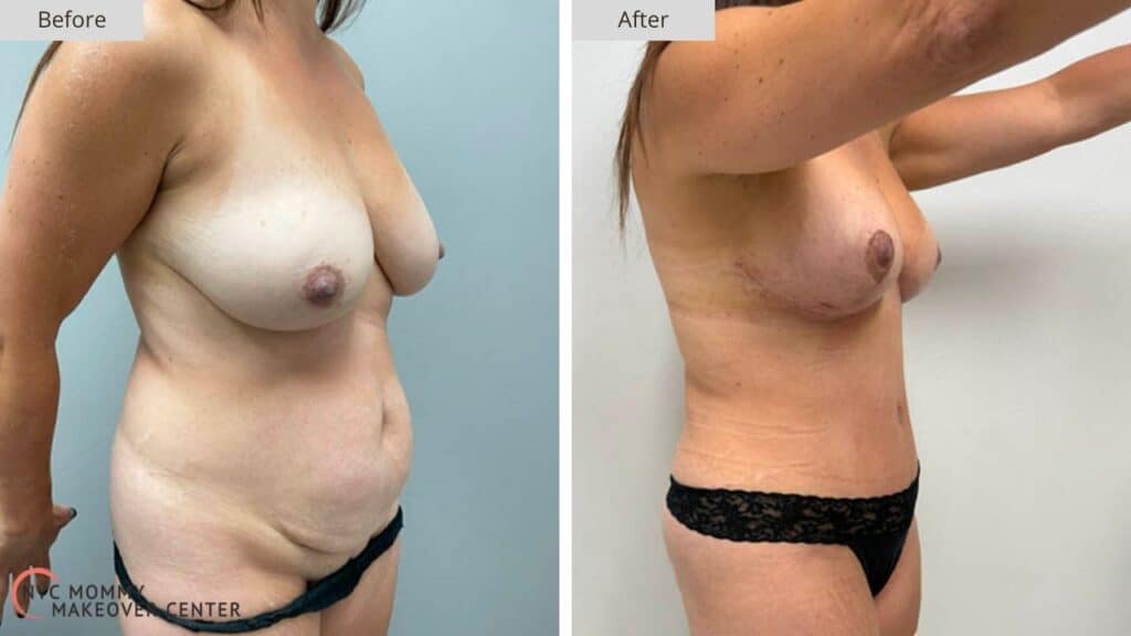Mommy Makeover NYC Before and After #6e