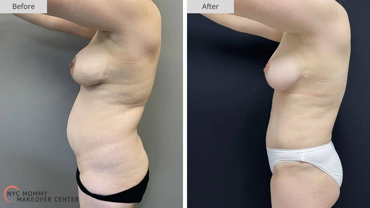 Mommy Makeover NYC Before and After #7a