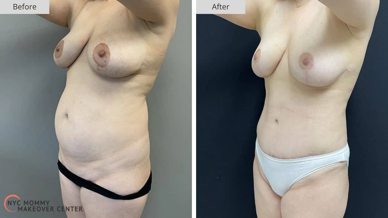Mommy Makeover NYC Before and After #7b