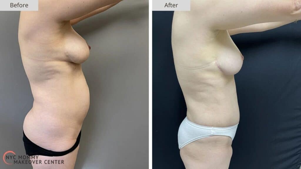 Mommy Makeover NYC Before and After #7c