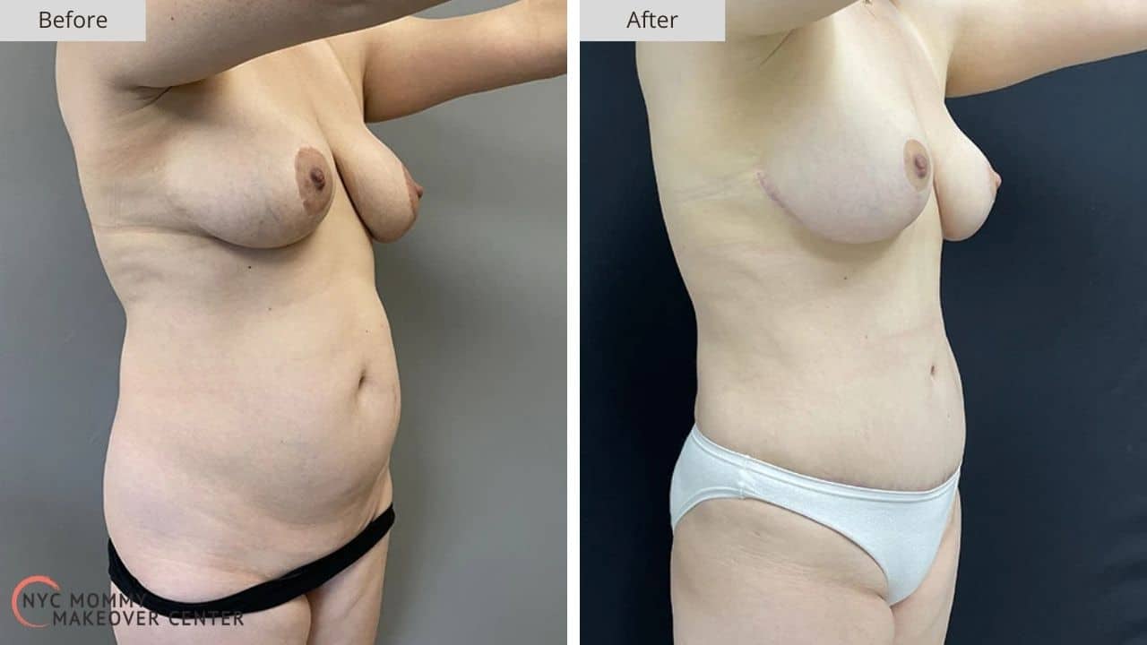 Mommy Makeover NYC Before and After #7d