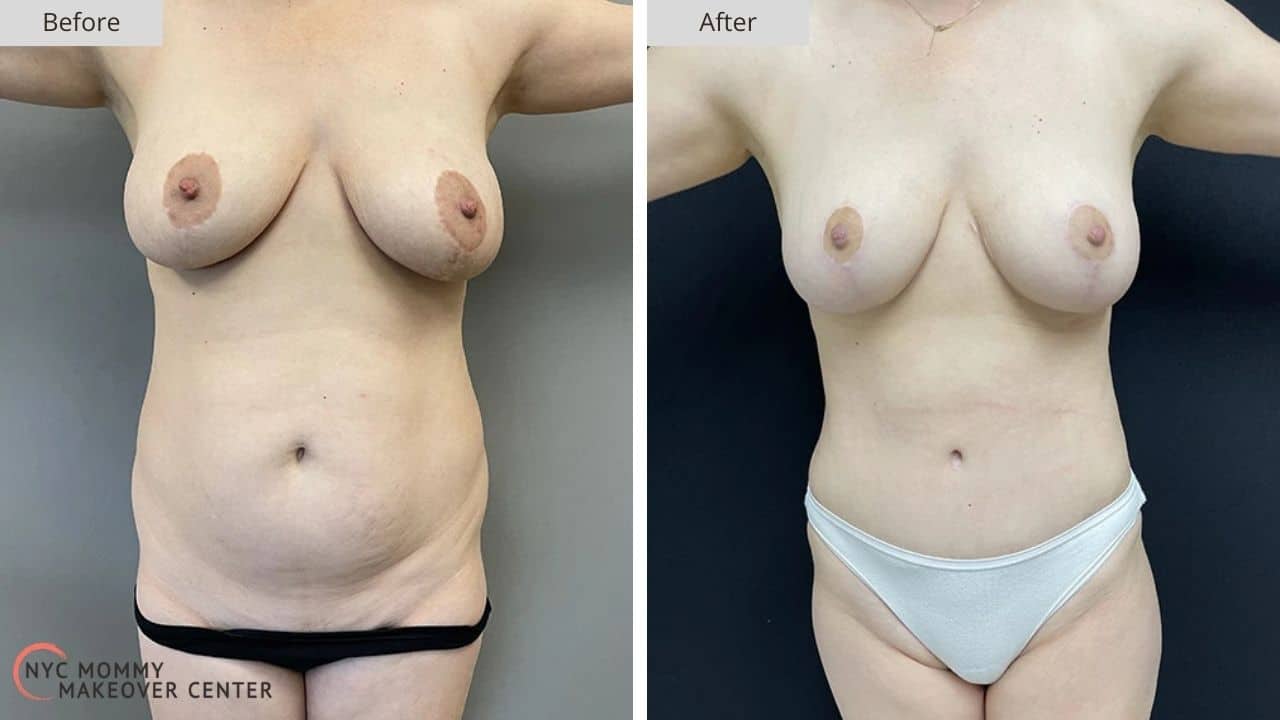 Mommy Makeover NYC Before and After #7e