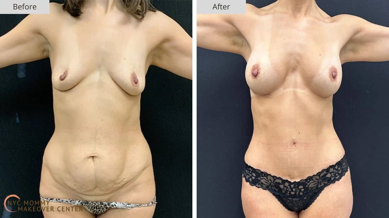 Mommy Makeover NYC Before and After #8a
