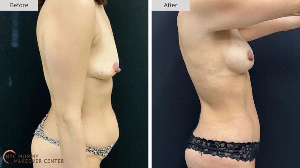 Mommy Makeover NYC Before and After #8c