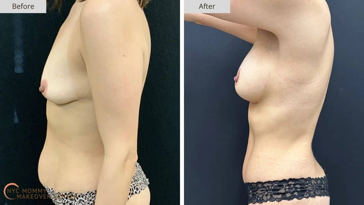Mommy Makeover NYC Before and After #8e