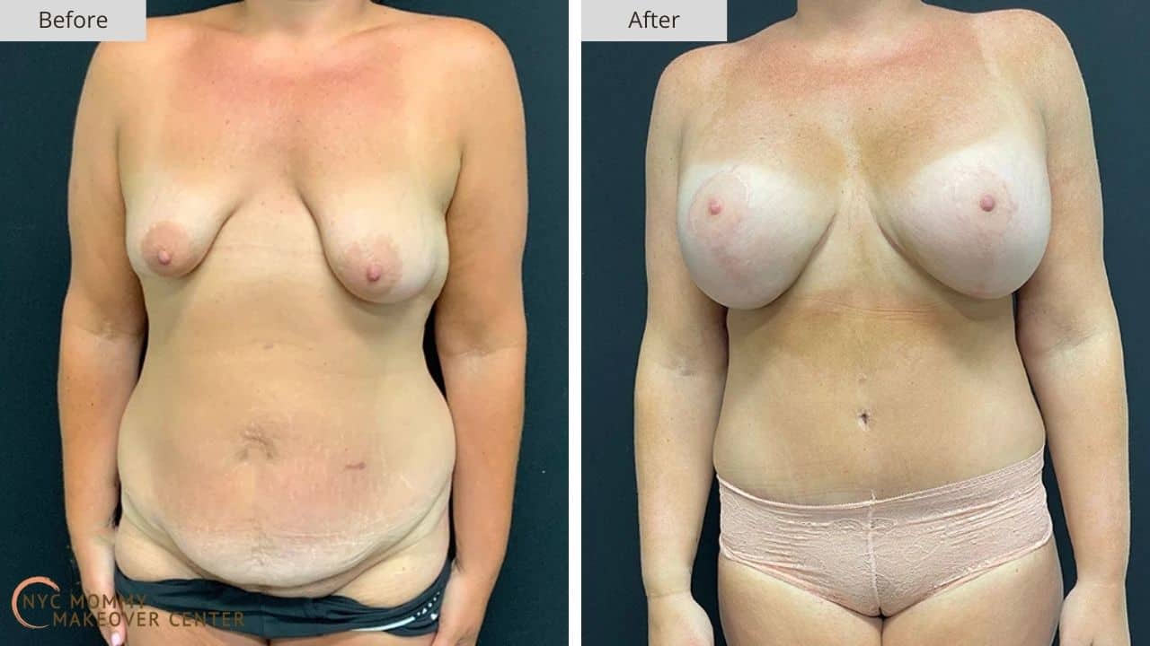 Mommy Makeover NYC Before and After #9a