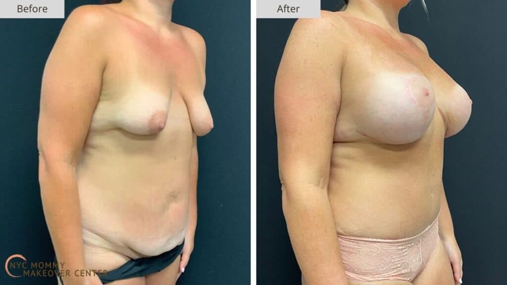 Mommy Makeover NYC Before and After #9b