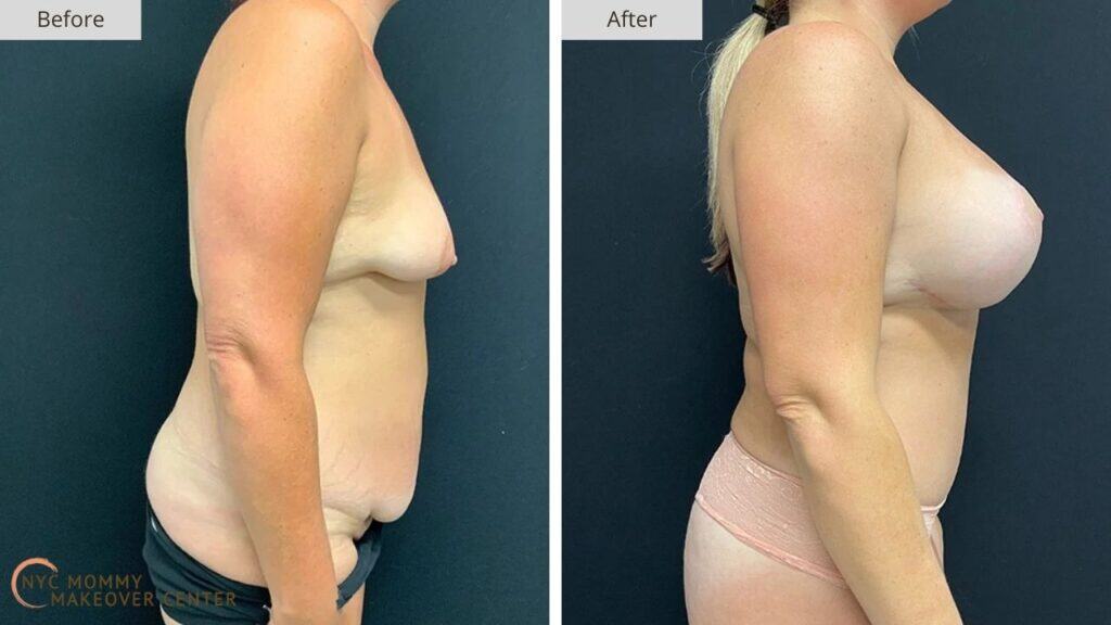 Mommy Makeover NYC Before and After #9c