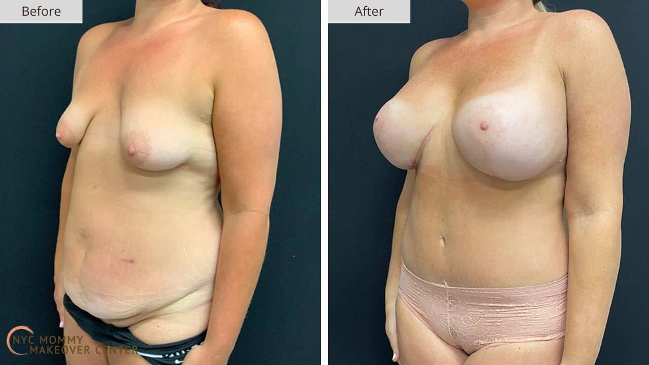 Mommy Makeover NYC Before and After #9d