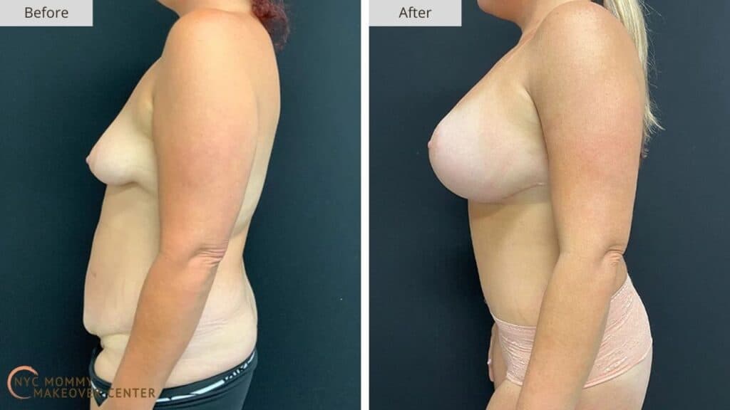 Mommy Makeover NYC Before and After #9e