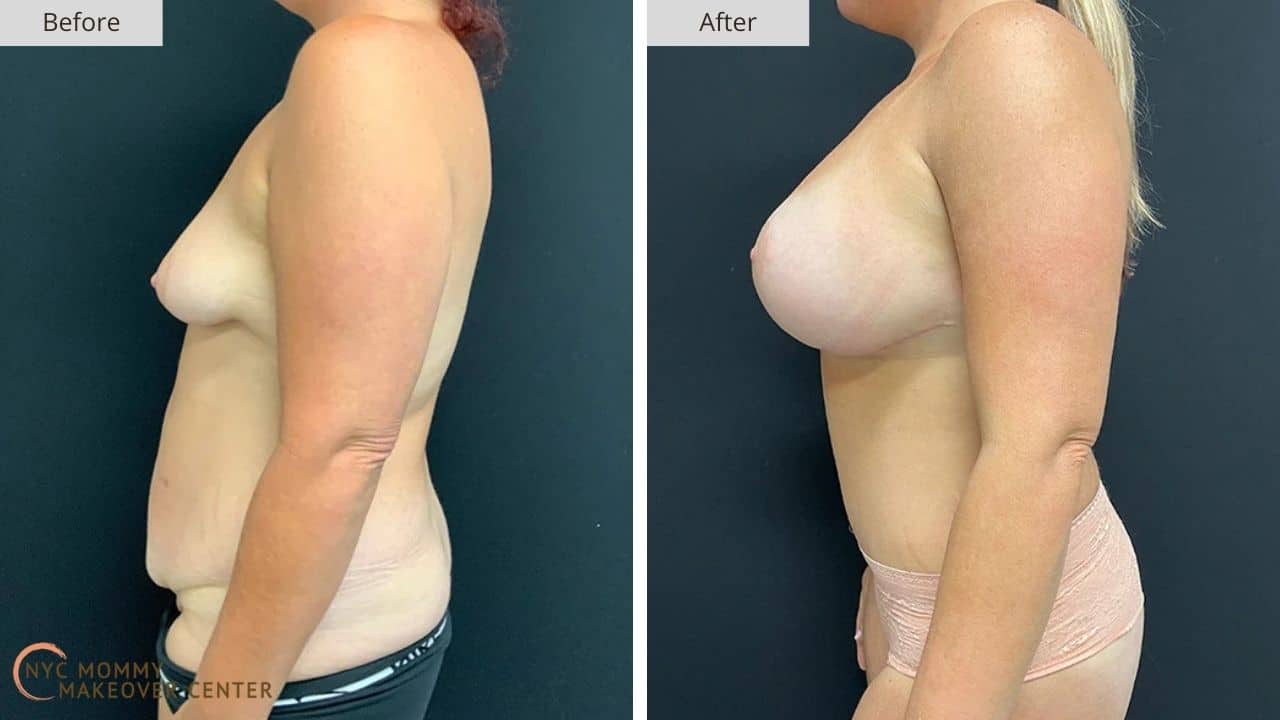 Mommy Makeover NYC Before and After #9e