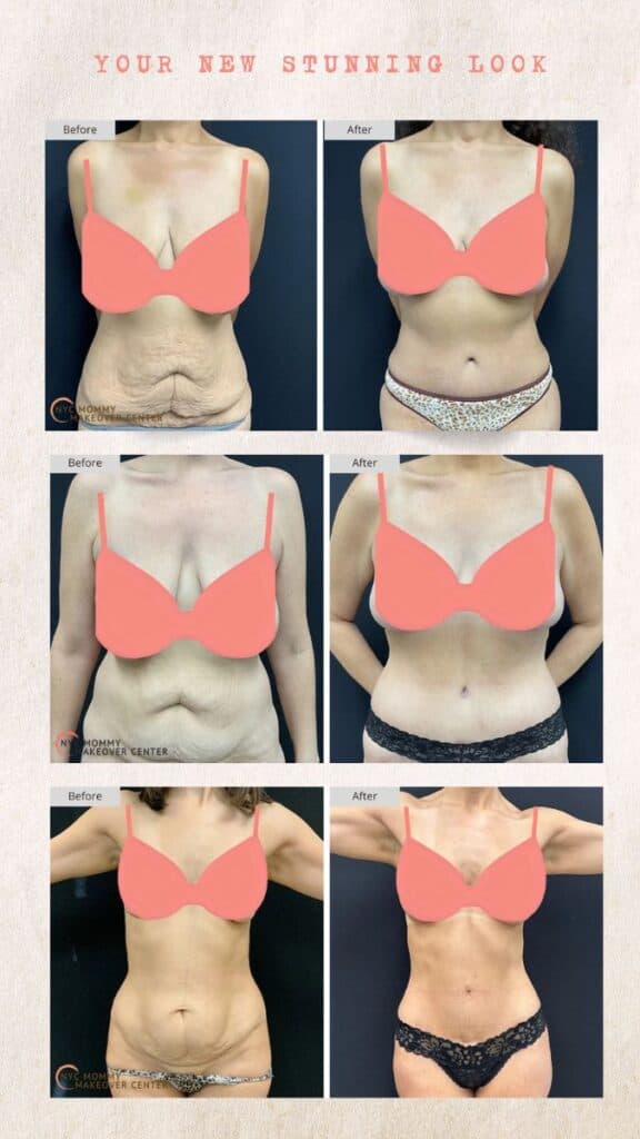 Mommy Makeover NYC Results