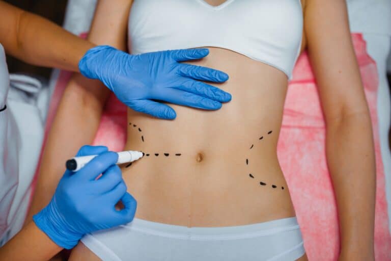 surgeon in blue latex gloves marking woman's abdomen