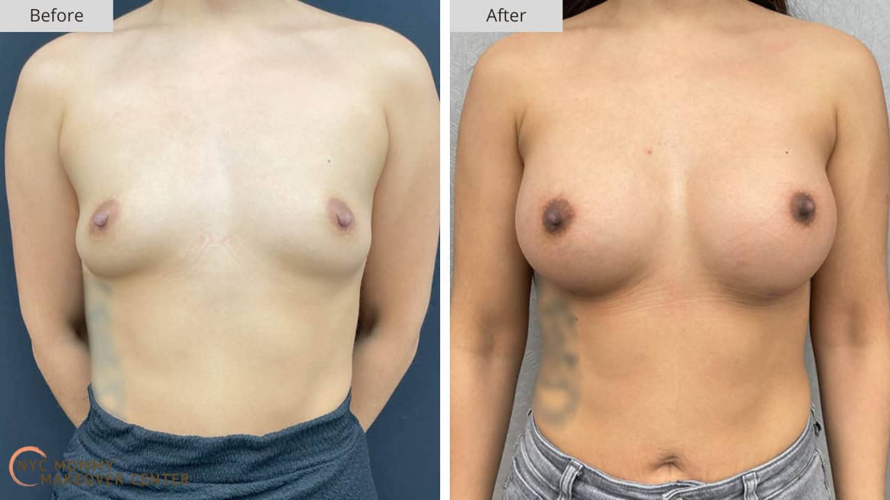 Mommy Makeover NYC Breast Augmentation Before and After #1a