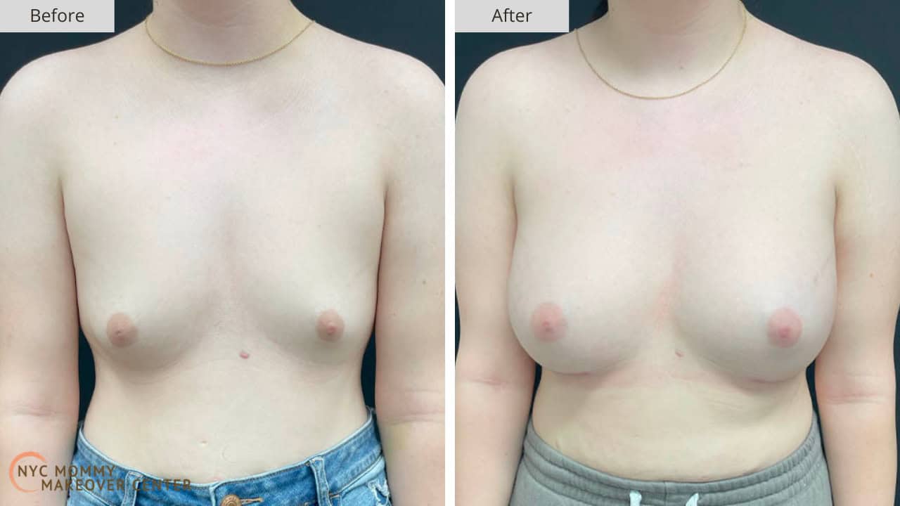 Mommy Makeover NYC Breast Augmentation Before and After #2a