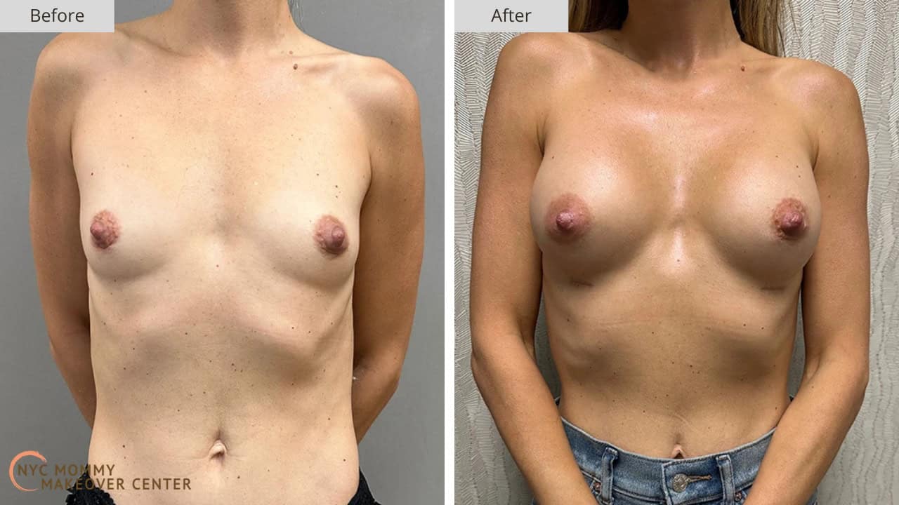 Mommy Makeover NYC Breast Augmentation Before and After #3a