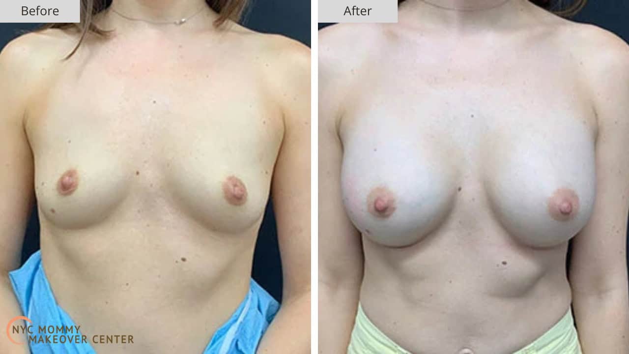 Mommy Makeover NYC Breast Augmentation Before and After #4a