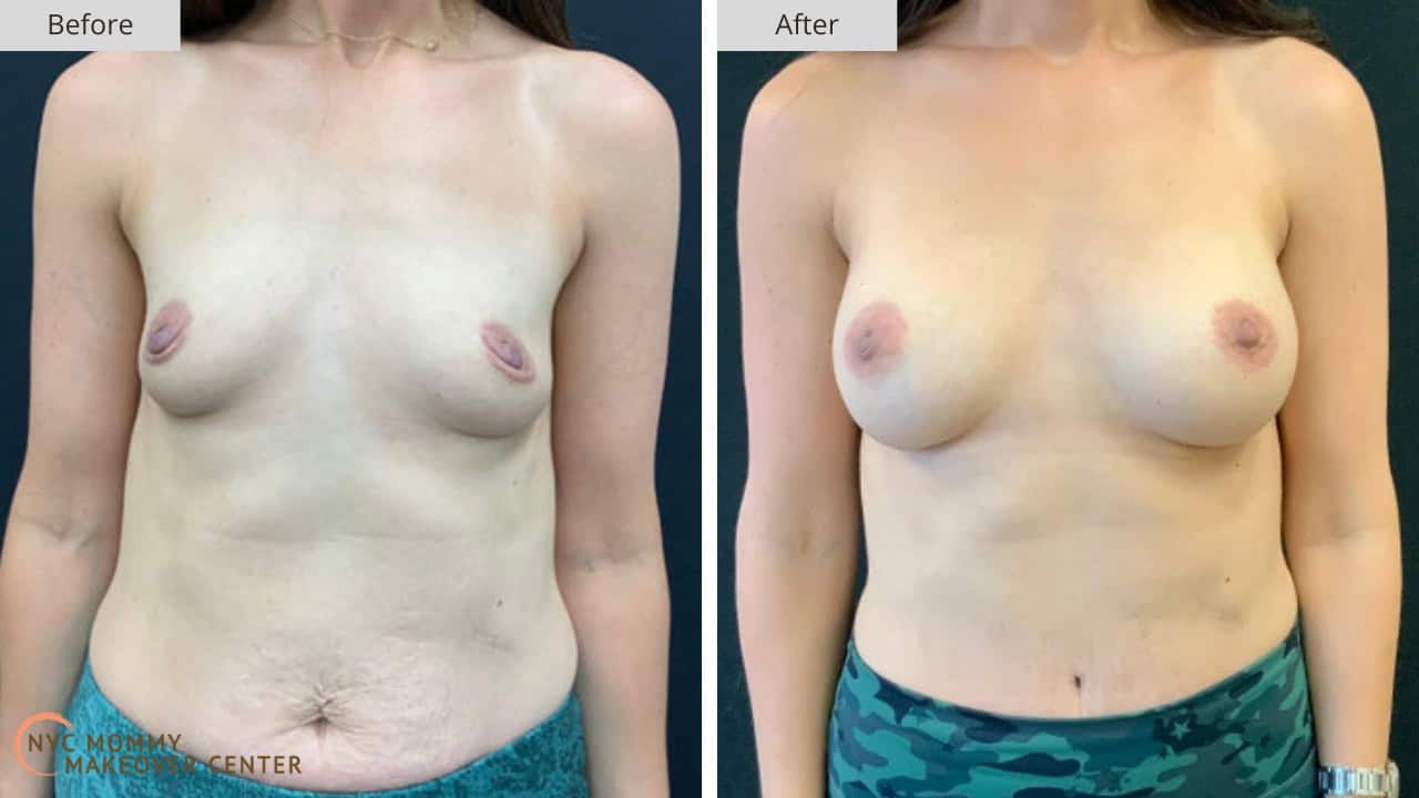 Mommy Makeover NYC Breast Augmentation Before and After #5a