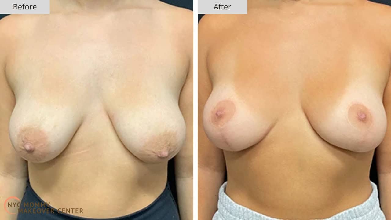 Mommy Makeover NYC Breast Lift Before and After #1a